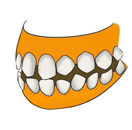 Zahnlücken